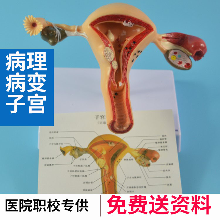 子宫病理解剖模型 女性生殖卵巢子宫病变结构模型 医院职校教具