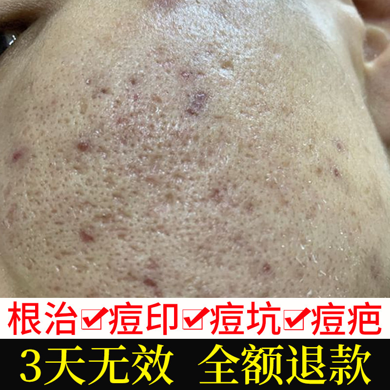 Salicylic acid acne scar removal acne scar repair gel anti-inflammatory cream skin care products redness and swelling fade artifacts for men and women