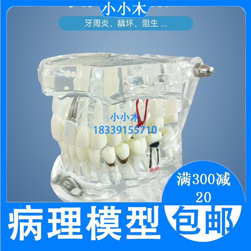 牙科材料 修复牙模型 水晶病理牙模型 活动种植牙模型 包邮