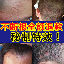 Head mite Divine Instrumental Scalp Clean to Serious Head Dandruffs gram Stars Itchy shampoo Men and women Control Oil