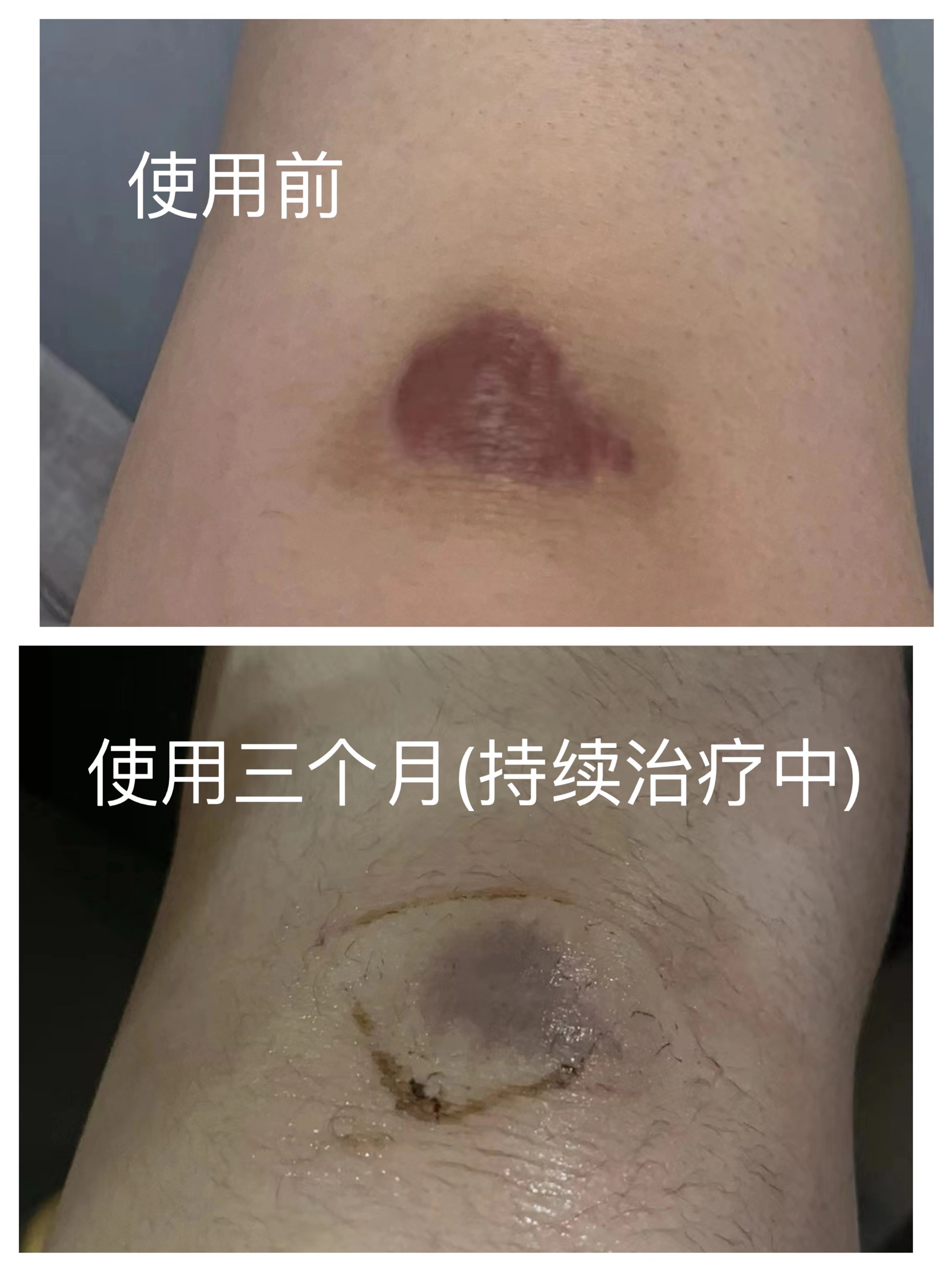Repair of scar Hyperplasia Softening of Goose Bumps Traditional Chinese Medicine Patch Burn Scalds-Taobao