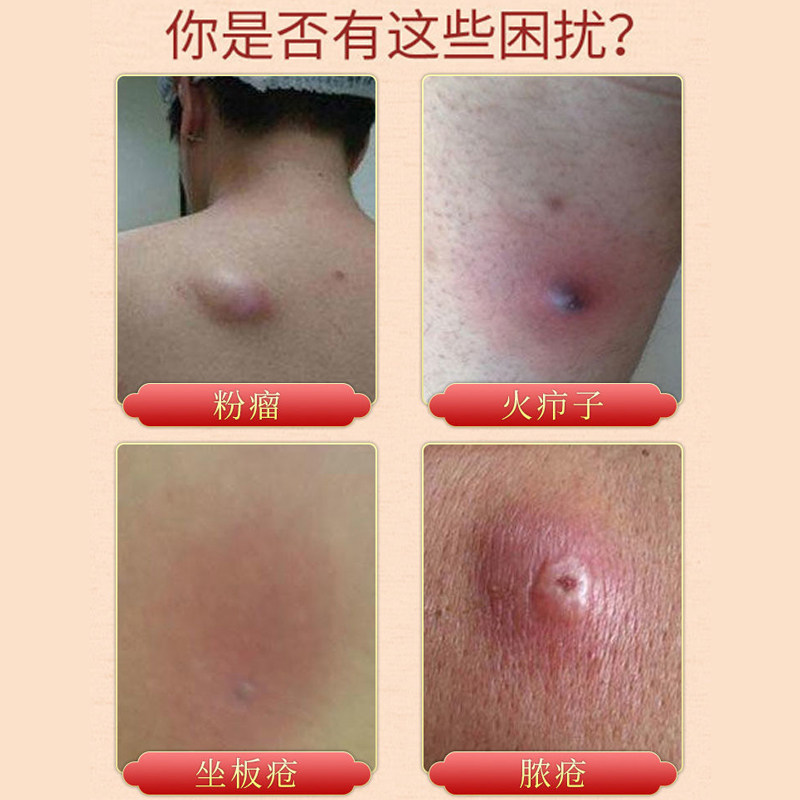 皮脂腺囊腫膏治粉瘤皮下囊腫青春痘結節硬塊火癤子拔毒拔膿藥膏神器 Taobao
