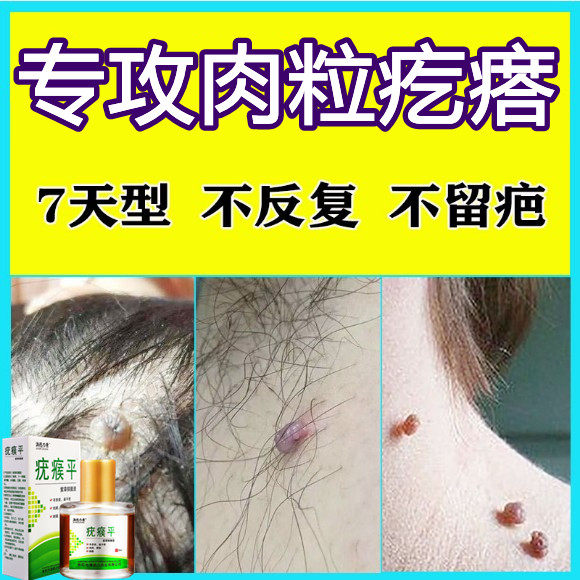 Remove monkey neck with small granules and armpits to remove artifacts anointed powder pointing to the flesh mole and wart throat