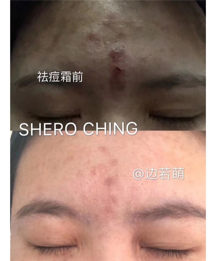 New SHERO CHING Hilo Perilla Acne Kem điều hòa làm dịu da khử sắc tố Sửa chữa mụn trứng cá Pockmark kem dưỡng ẩm skin1004