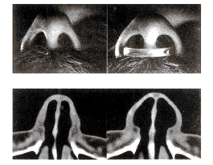 Nozovent??1??70??1??73 improves nasal airflow so that it increases above normal