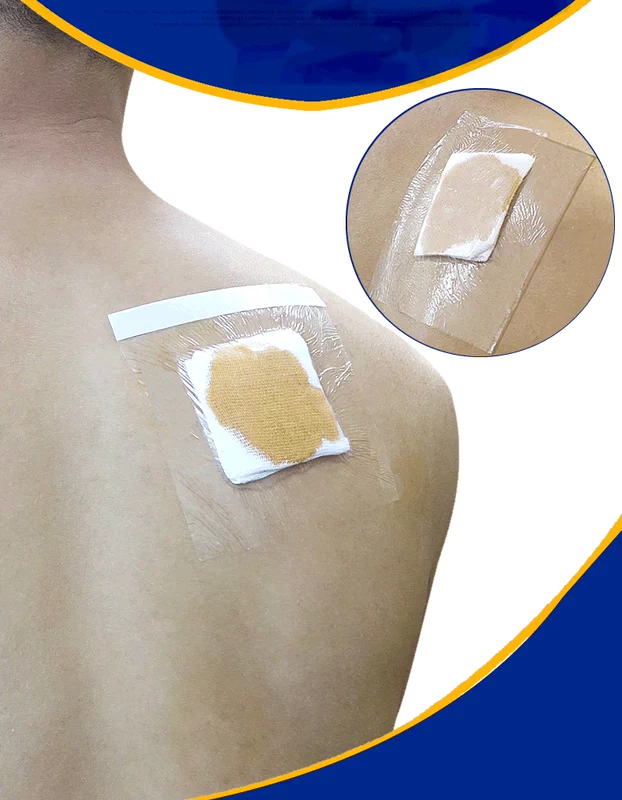 Nhãn dán phim PU chống nước Hongsheng Vải cao su y tế Ba volt Paste AI Paste Patch Patch Weak Lấy gạc