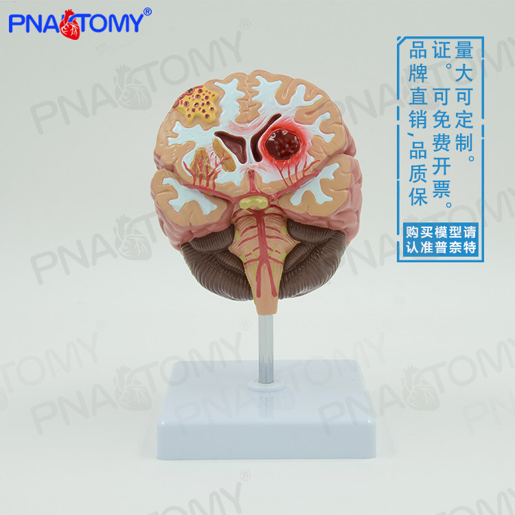人脑病理解剖模型脑梗大脑疾病脑血管堵塞标本医用脑科神经科