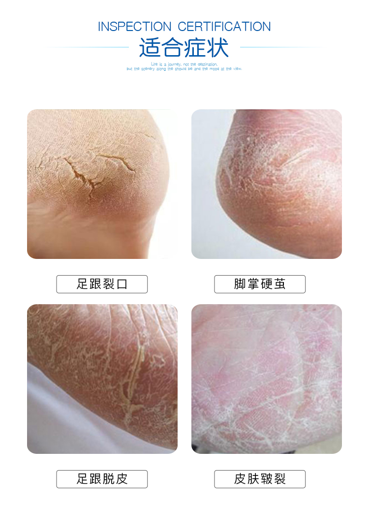 Đức Jiewo chân kem chăm sóc khô kem chân khô nứt chân khô nứt chân nứt tay và chân khô nứt kem 75 ml kem bôi gót chân