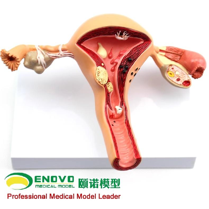 ENOVO 人体子宫 卵巢 阴道 病变模型 生殖科妇科演示模型
