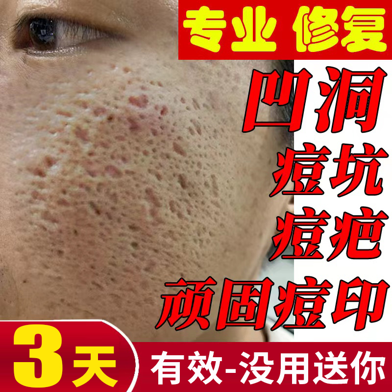 Acne Scar Repair Growth Factor Men's Acne Scar Removal Micro-Needle Cream Filling and Regenerating Cream to Reduce Acne Marks and Scars Acne Scar Repair Growth Factor Men's Acne Scar Removal Micro-Needle Cream Filling and Regenerating Cream to Reduce Acne Marks and Scars