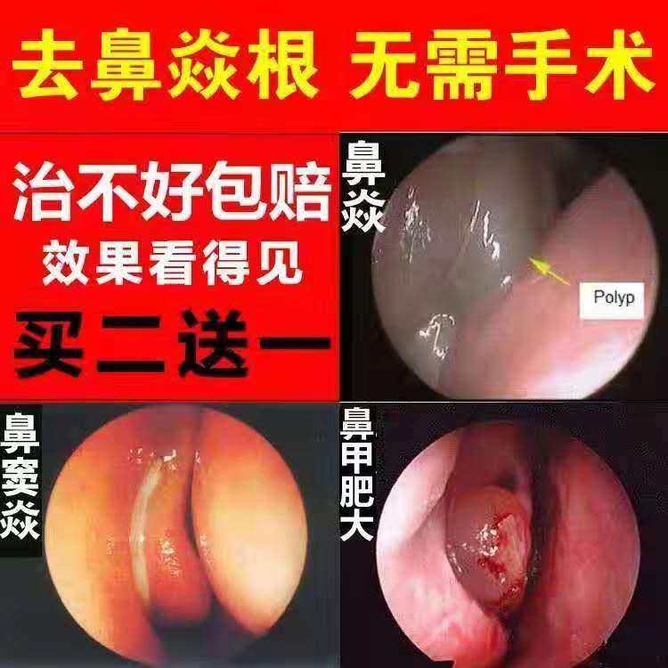 Miao's goose does not eat grass Allergic rhinitis cures nasal polyps nasal congestion sinusitis nemesis Japanese earth medicine