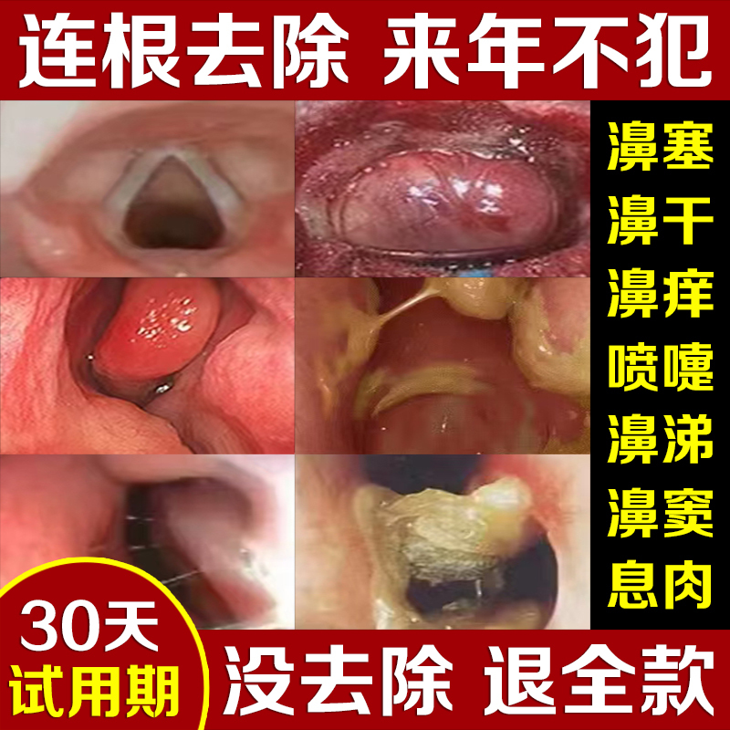Specialized Nasal Allergy Dry Itching Inflammation Treatment Spray for Children and Adults, Effective for Sinus Hypertrophy and Polyps