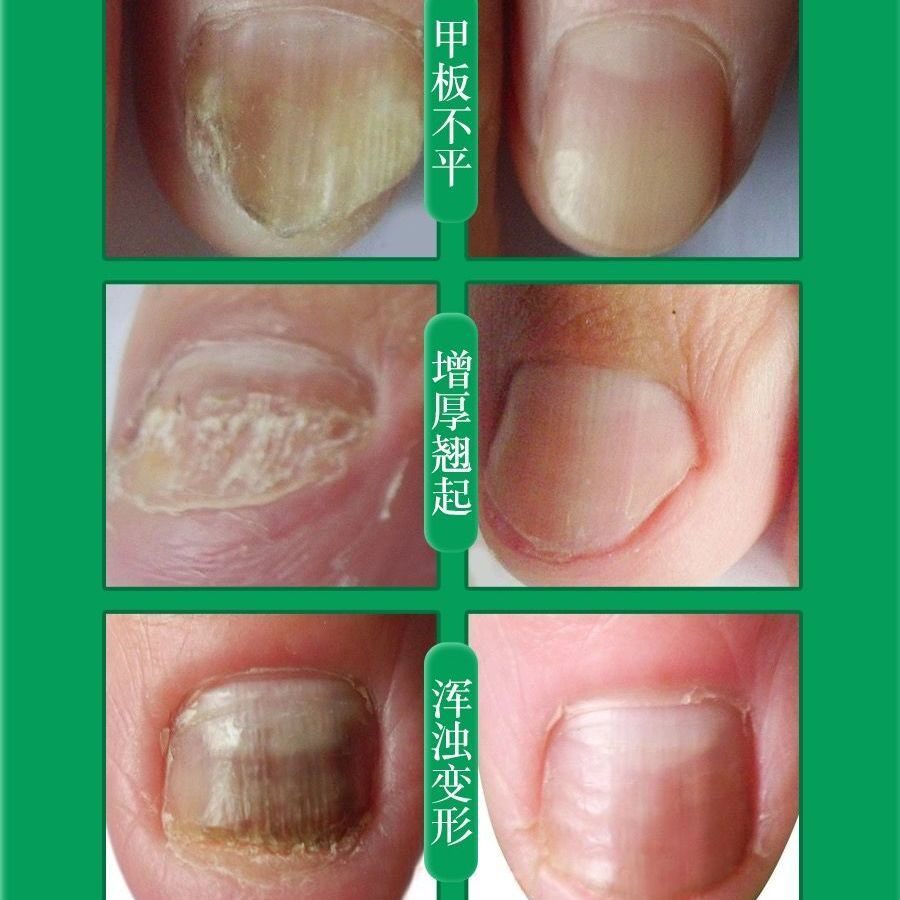 Nail fungus scissors special electric nail polisher thick nails old man's nail polisher manicure knife gray thick