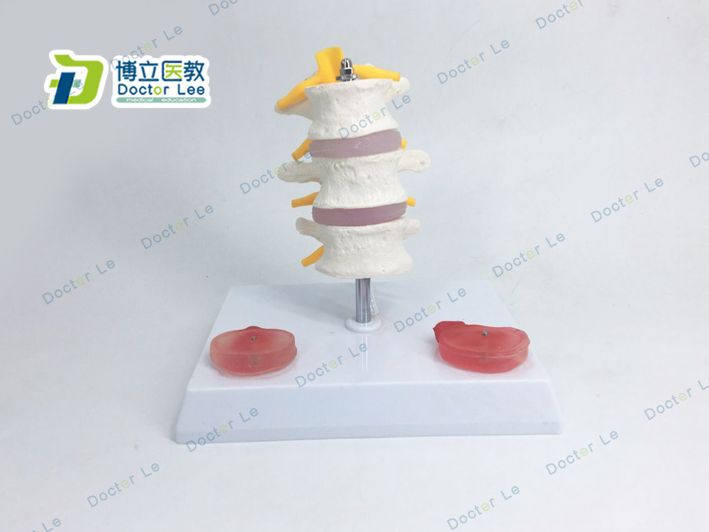 苏州厂家直销 3节腰椎带腰间盘病变模型 椎间盘模型腰椎模型