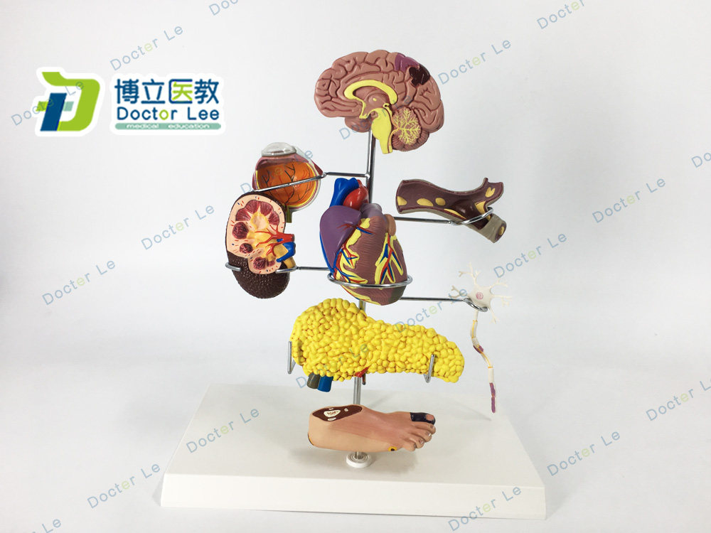 人体医学糖尿病模型并发症大脑心脏胰腺神经元足内外科