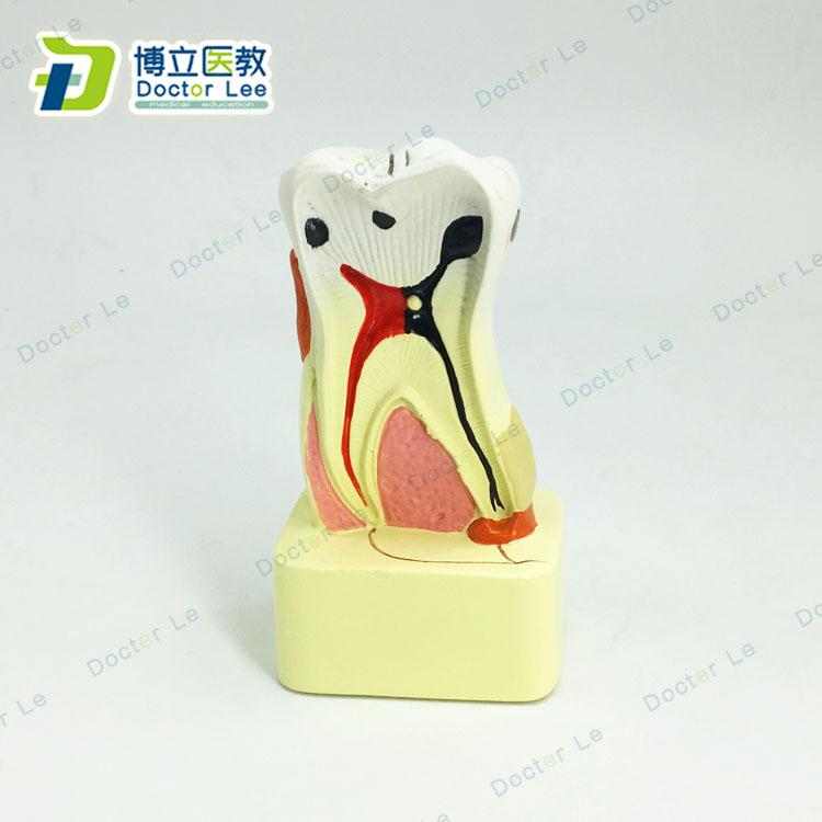 牙科模型四倍龋齿演变模型蛀牙演示医患沟通龋齿发展病理分解模型