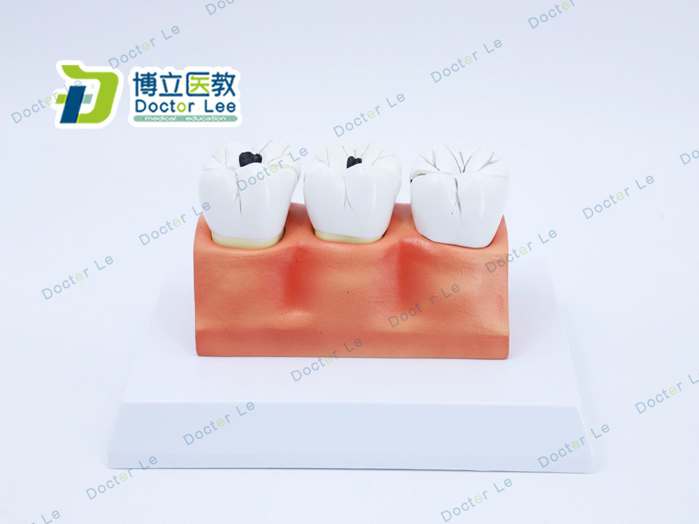 教学仿真龋齿模型牙齿模型病变牙齿模型3颗龋齿模型龋齿分解模型