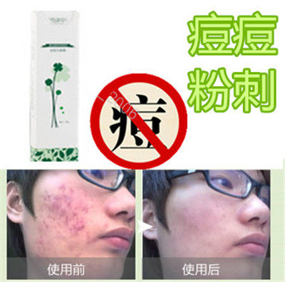 After removing the back closed acne acne men and women medicinal cream acne removal chest blackhead acne scar repair liquid
