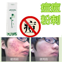 Remove closed back acne men and women medicinal cream acne remover chest blackheads and acne scar repair solution