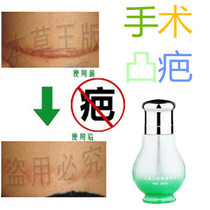 Remove mens and womens stitches reduce caesarean section bumps eliminate postpartum scars and repair fluid for postpartum scars