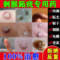 The Assassin is Good for Treatment of Wart Metatarsal of Metatarsal Metatarsal and Sarcoma Removal Cream of Spurs Spurs Monkey Spurs Special Medicine
