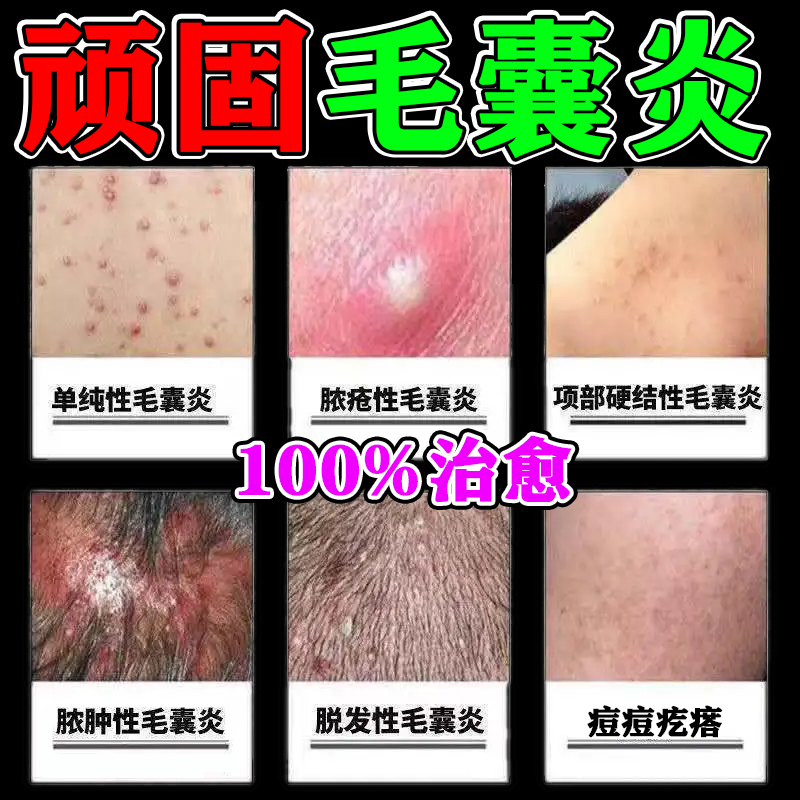 Treatment of the special medicine for follicles head scalp on the back of the chest of pus and pimples to root the pimple