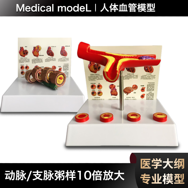 血管动脉化模型人体血管病变模型血管解剖医学教具血管解剖模型