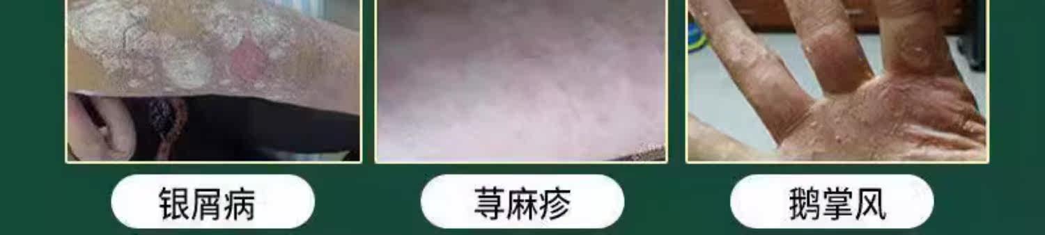 Антибактериальные карта 断痒杀毒膏头皮疙瘩背部痤疮痘痘全身皮肤瘙痒蚊虫叮咬消肿止痒膏