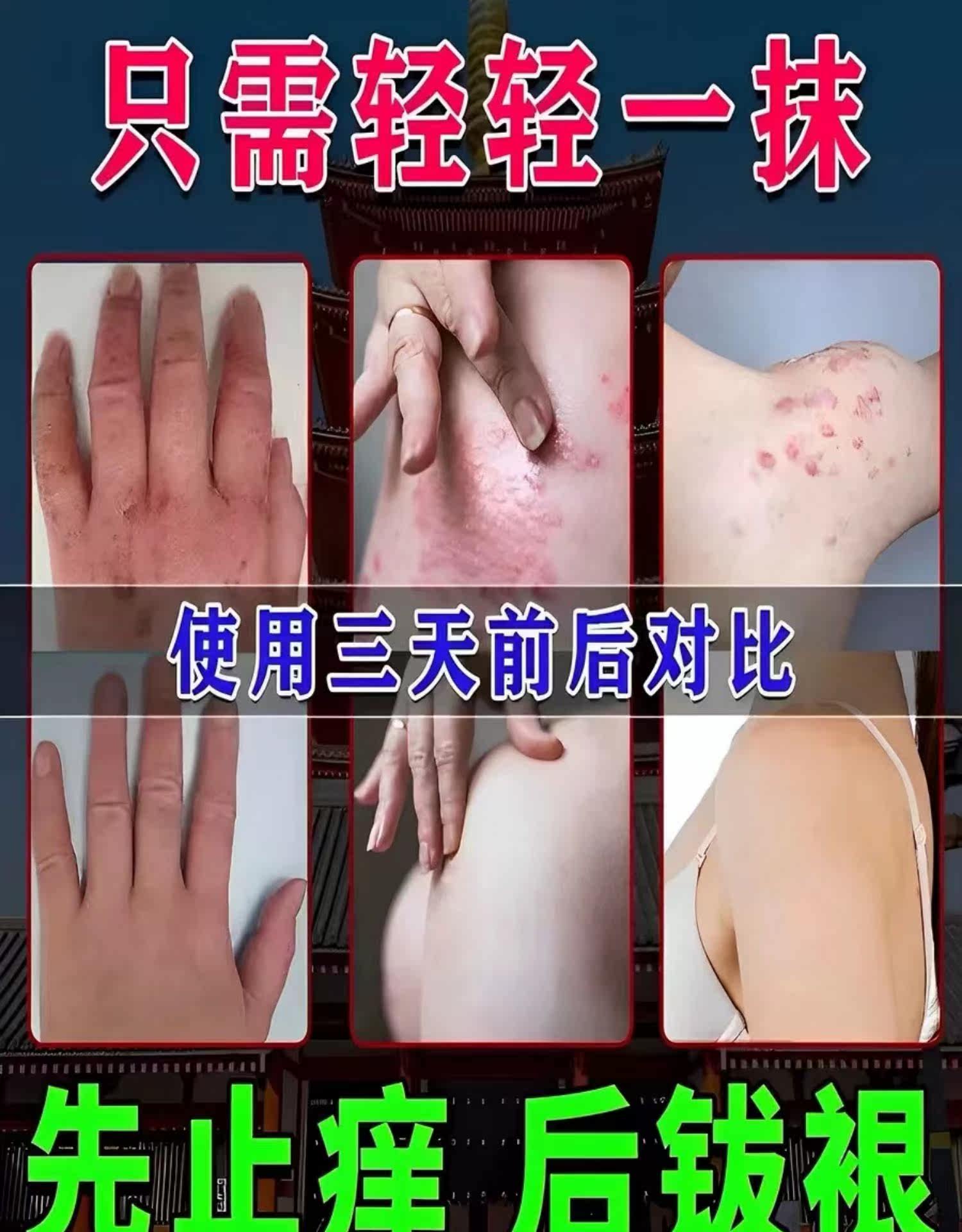 Антибактериальные карта 断痒杀毒膏头皮疙瘩背部痤疮痘痘全身皮肤瘙痒蚊虫叮咬消肿止痒膏