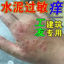 Cement allergy building special anti-itching root and stubborn cracking of itching skin with fungal peeling itching