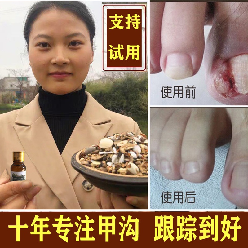 【Reputable】Specialized Nail Groove Treatment Ointment for Ingrown Toenail Inflammation, Toenail Removal, and Softening Agent for Removing Polyps, Eliminating Swelling, and Eliminating Nail Growth into the Flesh 【Reputable】Specialized Nail Groove Treatment Ointment for Ingrown Toenail Inflammation, Toenail Removal, and Softening Agent for Removing Polyps, Eliminating Swelling, and Eliminating Nail Growth into the Flesh