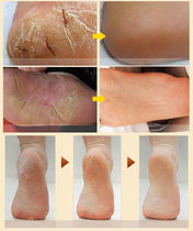 Read the Kirins skin care cream inexhaustible hand foot dry cracked feet heel dry cracked anti-crack cream foot crack repair paste