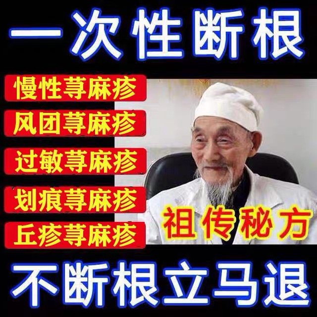 Urticaria allergies, allergies, antipruritics, special medicines for eliminating root causes