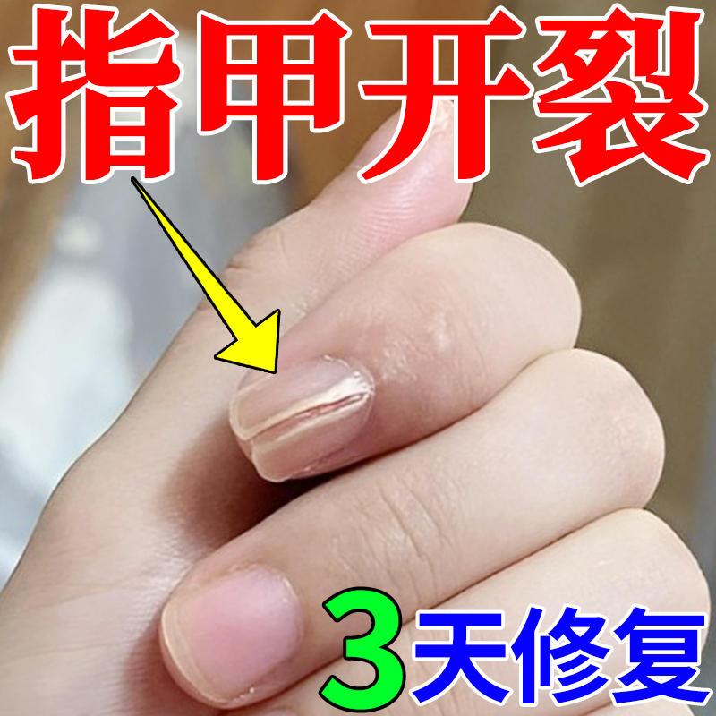 Nail Crack Repair, Nail Bed Growth Solution, Vertical Lines, Damaged Nail Flesh Separation, Treatment of Nail Surface Layering, Hollow Nails, Uneven Surface