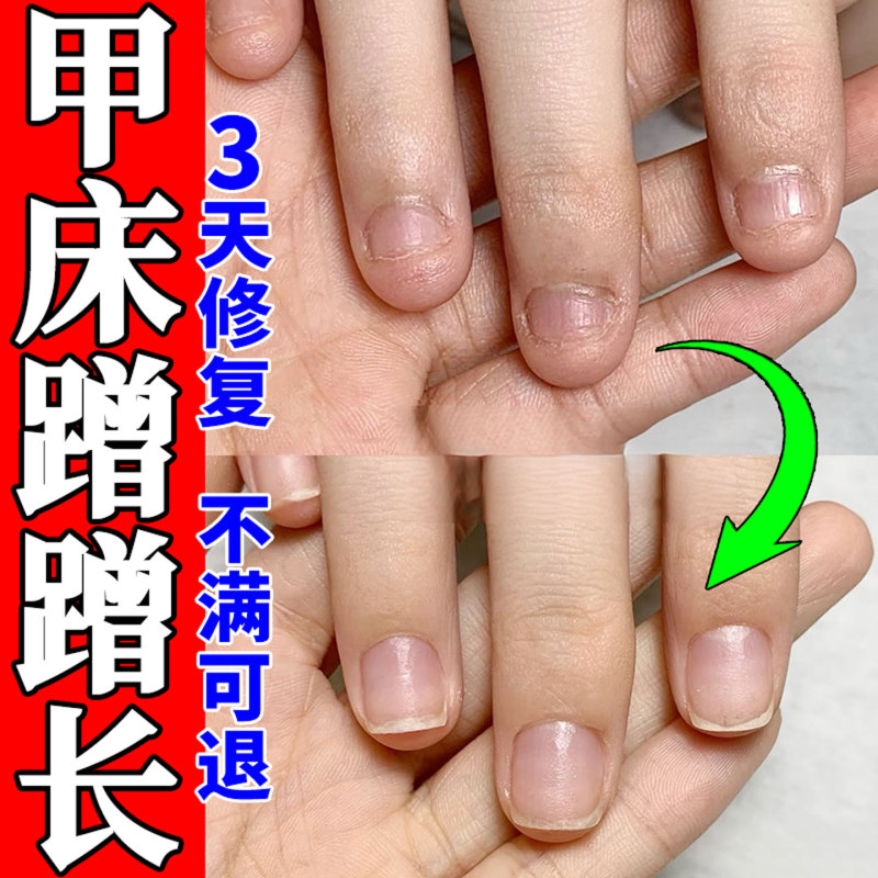 Nail Bed Growth Liquid for Repairing and Nourishing Damaged and Shrinking Children's Nails, Rapid Growth Oil Nail Bed Growth Liquid for Repairing and Nourishing Damaged and Shrinking Children's Nails, Rapid Growth Oil