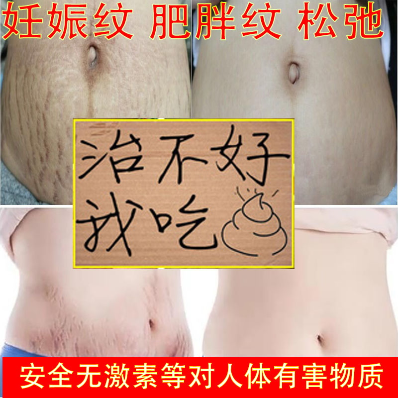 Stretch marks postpartum lightening fat repair cream removing breasts and breasts to eliminate pregnant women to prevent belly tightening renchen lines