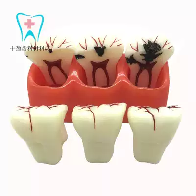 Dental oral teaching model 4 times caries model Removable large tooth decay evolution 3*1 Doctor-patient communication