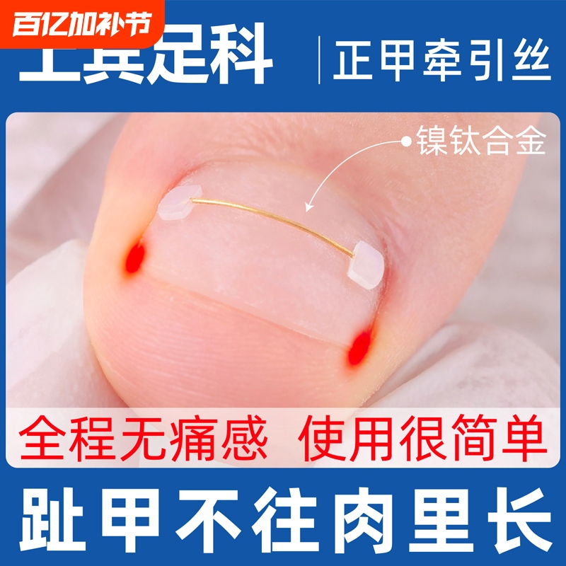 Nail Groove Correction Device, Nickel-Titanium Alloy Rebound Steel Wire, Ingrown Toenail Correction Patch, Toenail Inflammation Solution