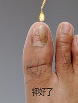 Li Jiaqi - = recommended pain-free removal of hands toe bad potassium without pain and no decchia effect is too good