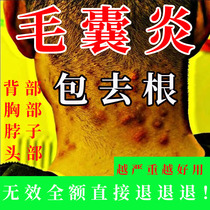 Special medicine for scalp folliculitis head neck back chest face pustules private parts scrotum acne and itching cream