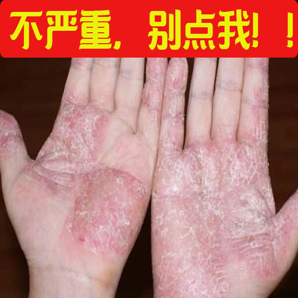 Cure Peeling Special Effects Cream Adult Metaskin Seasonal Repair Cream Nourishes Explosive Leather Hand Gas Shuang Fingers Feet Up Peel Back