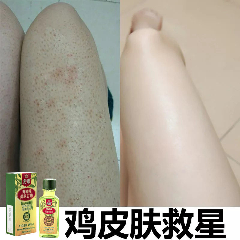 Go to the chicken skin hair follicles keratinocytes Periodontal moisturizing and moisturizing the skin to remove the fish scale Thigh Body Milk