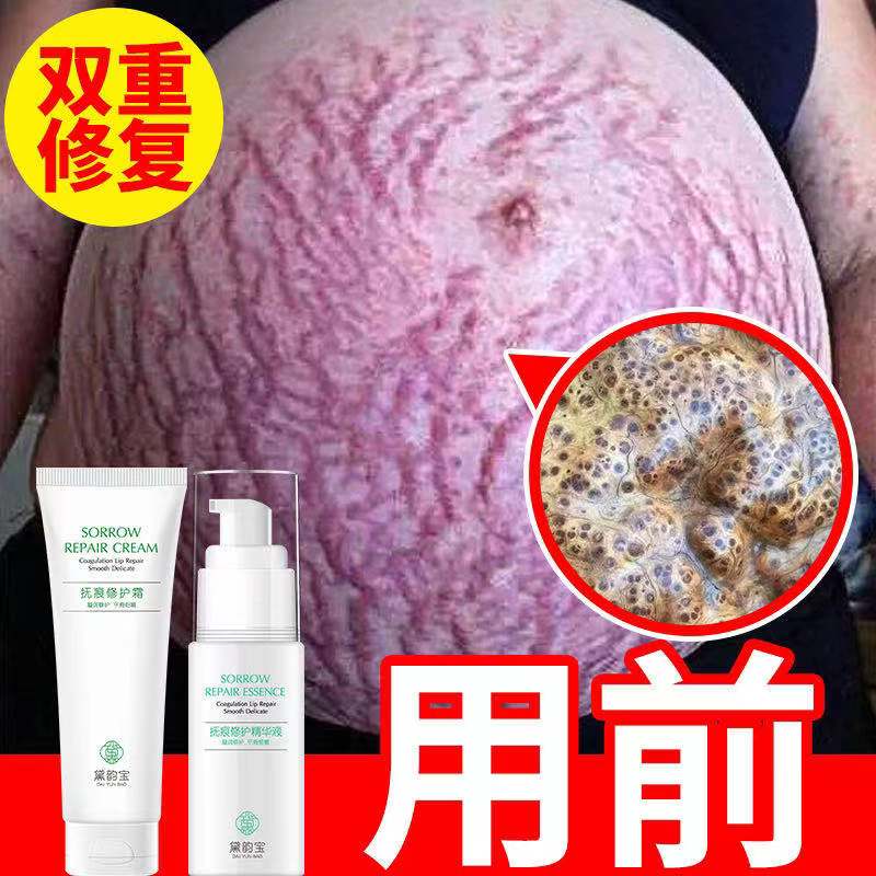 Pregnant women special prevention removal pregnancy removal pregnancy pregnancy pregnancy postpartum repair cream desalination olive oil to eliminate artifact obesity