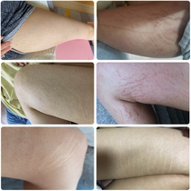 Removal of fat lines growth lines elimination of thigh students prevention desalination repair cream stretch marks postpartum elimination of firmness
