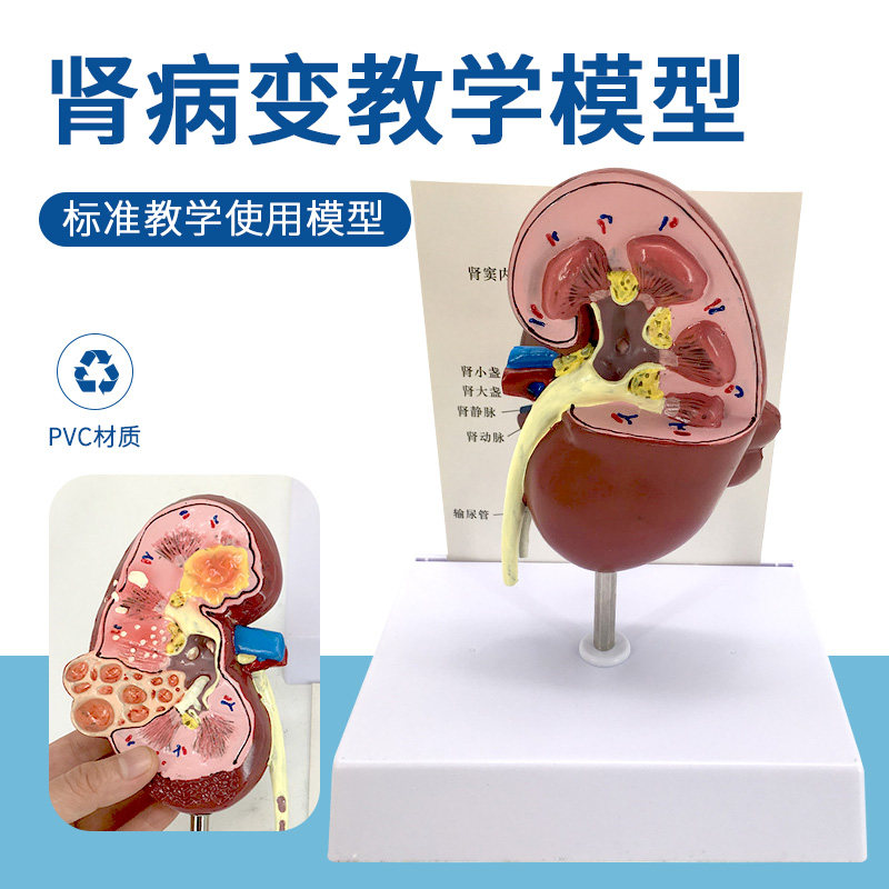 肾脏病变模型 泌尿科肾模型 肾小球 肾单位 肾脏解剖模型 肾解剖