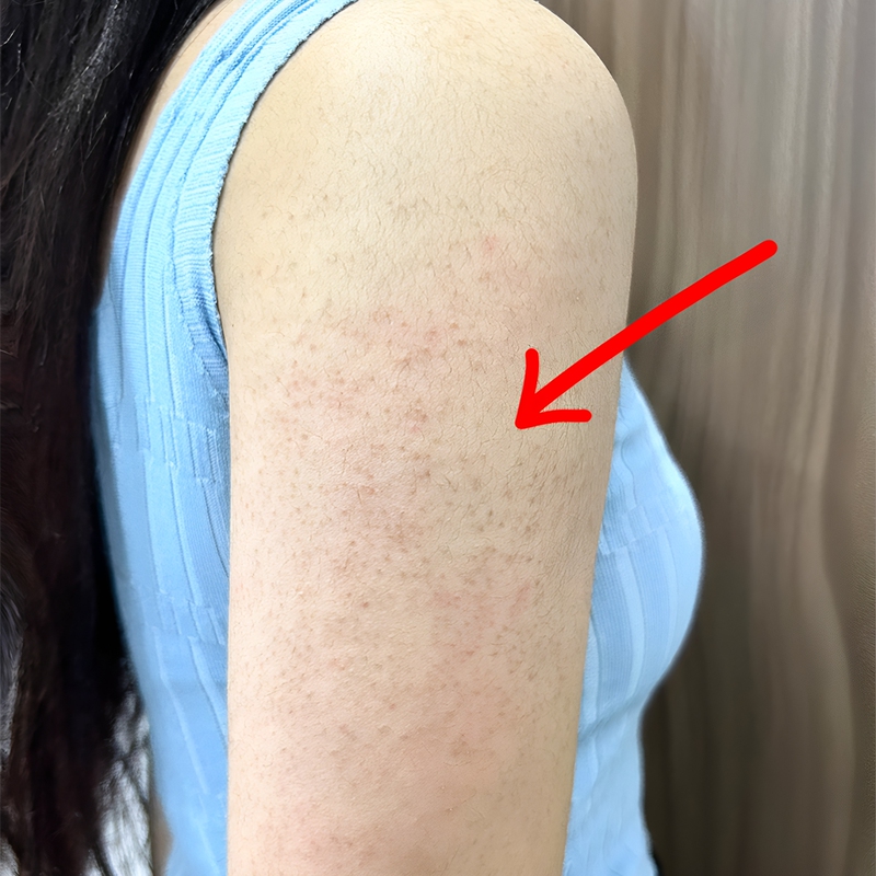 Neck and Arm Keratosis Pilaris Treatment Cream for Removing Skin Tags, Enlarged Pores, Clogged Pores, Red Spots, Black Spots, and Bumps Neck and Arm Keratosis Pilaris Treatment Cream for Removing Skin Tags, Enlarged Pores, Clogged Pores, Red Spots, Black Spots, and Bumps