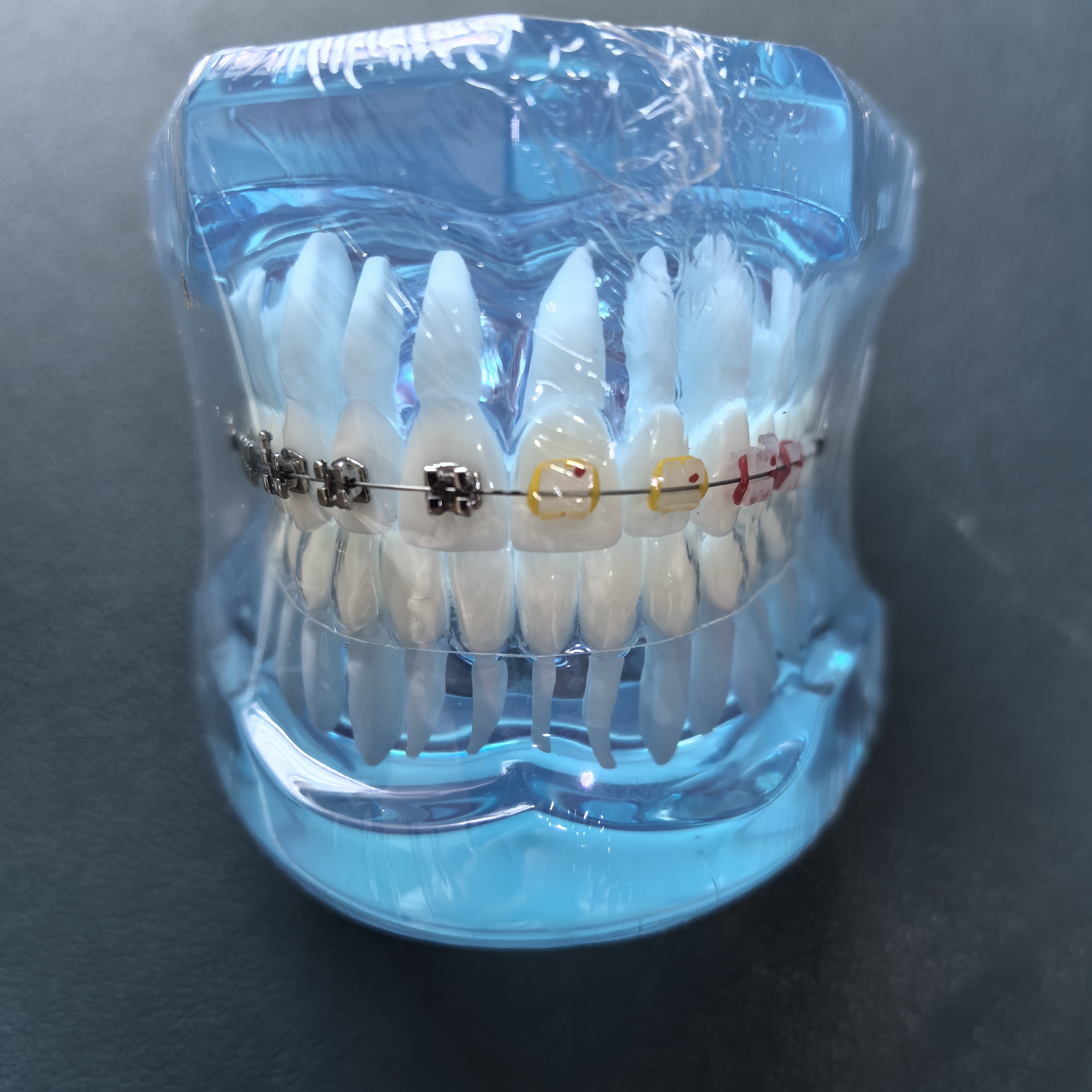 牙科口腔正畸模型隐形陶瓷托槽金属舌侧自锁3种托槽对比牙齿矫正
