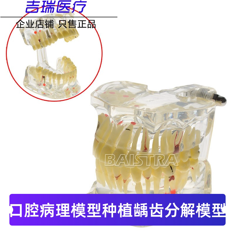牙科模型牙齿病理模型 医患沟通口腔教学成人牙水晶模型修复模型