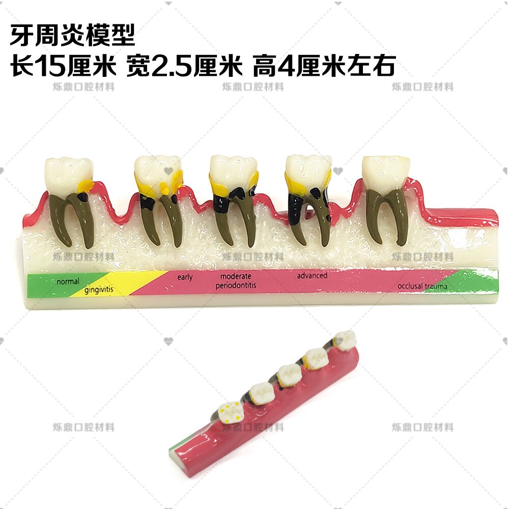 烁蒂牙科牙模牙周炎口腔龋齿演变讲解分析模型学习教学医患沟通