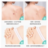 修正 Шрад остановился, шрамы лиц восстанавливают Scald Scald и гиперплазию подлинную подлинную подлинную